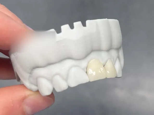 Couronnes céramiques antérieures sur modèle, réalisées au laboratoire